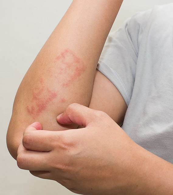 eczema vs psoriasis pictures hands vörös folt mint a mantu a lábán